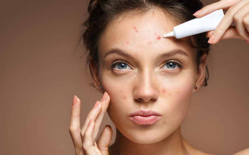 Cách Chăm Sóc Da Mặt Bị Mụn bằng cách sử dụng thuốc điều trị mụn